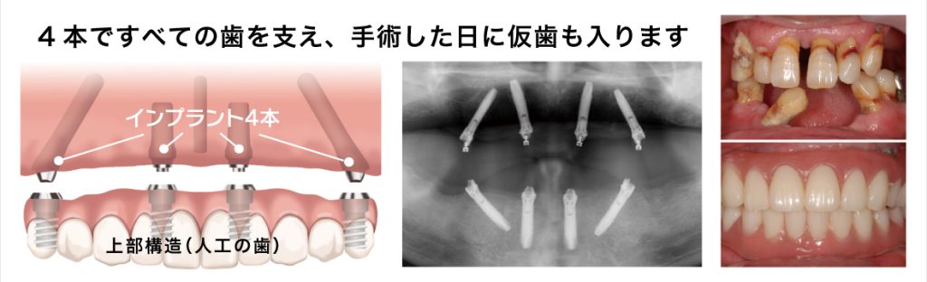 ALL-on-4インプラント（インプラント治療）4本ですべての歯を支え、手術した日に仮歯も入ります
