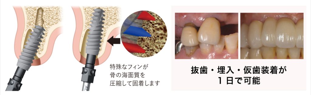 抜歯即時埋入方　特殊なフィンが骨の海面質を圧縮して固着します　抜歯・埋入・仮歯装着が1日で可能